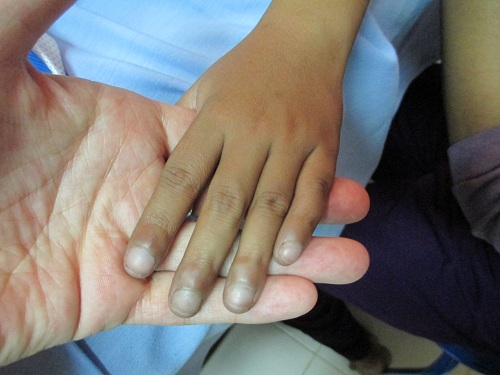 Blue hands Cambodian cardiac patient